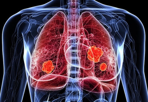 Thuốc Mới Điều Trị Ung Thư Phổi Đột Biến KRAS Hiệu Quả